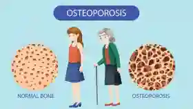 Mitos atau Fakta: Perempuan Lebih Rentan Alami Osteoporosis?
