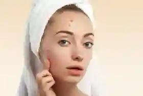  Perhatian Gen Z! Jajan Sembarangan Bisa Bikin Jerawatan!